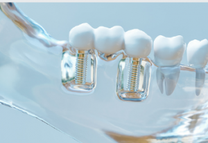Adelaide dental implants